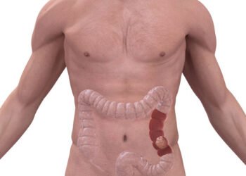 Cáncer de colon en menores de 50 años: conocé cómo evitarlo